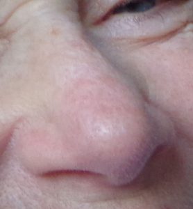 Hooikoorts blussen met voeding